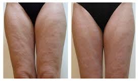 before-and-after-cellulite