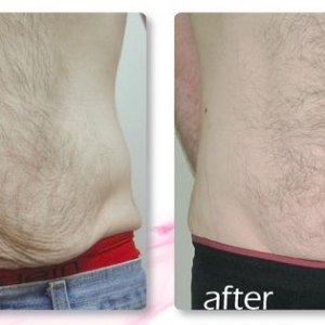 before-and-after-man-skin-tightening