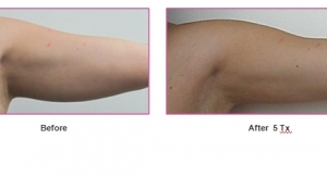 before-and-after-treatment-arms-tightening